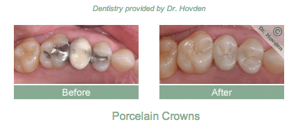 dental crown repair in Daly City and Pacifica