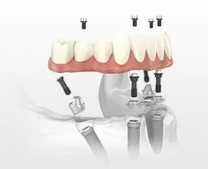 Implant supported dentures diagram from dentist in Daly City