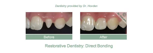 restorative dentistry with dental crowns and dental bridges in South San Francisco