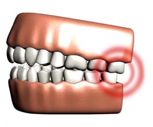 TMJ treatment with a Daly City dentist near Pacifica and South San Francisco