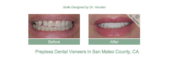 Dental veneers in South San Francisco with Dr. Hovden, DDS