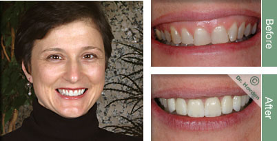 porcelain veneers and dental veneers with a South San Francisco dentist in Daly City