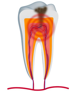 root canals for tooth pain relief with a Daly City dentist near Pacifica