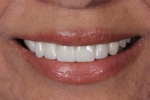 Before and after cosmetic dentistry treatment with Dr. Hovden, DDS