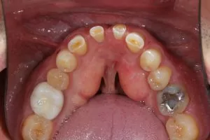 A before photo of a restorative dentistry patient.