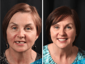 Daly City dental implant patient before and after photos