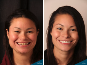 Daly City dental veneers patient before and after photos with Dr. Hovden