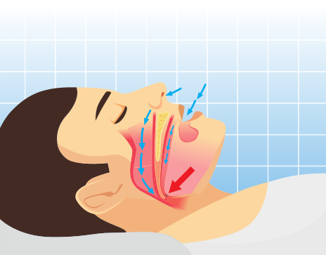 Airway obstruction diagram for snoring and sleep apnea