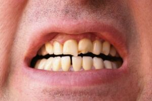A man with visibly broken and cracked teeth from untreated TMJ.