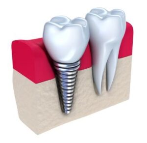 A graphic image of a dental implant after it has been installed in the jawbone.